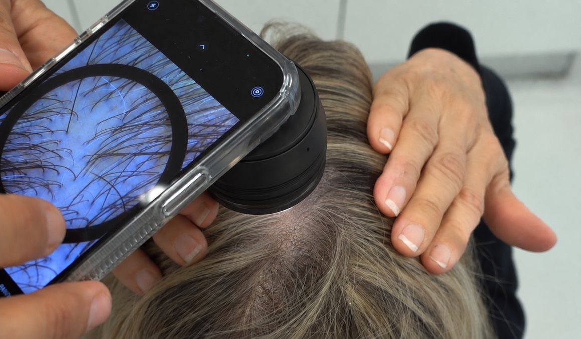 Dermoscopic scalp image captured with a supported device